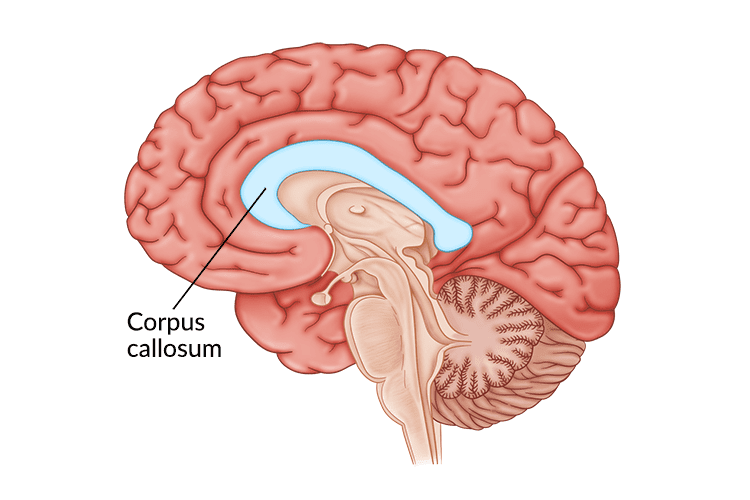 Corpus Callosum Stroke: Causes, Effects, & Treatment